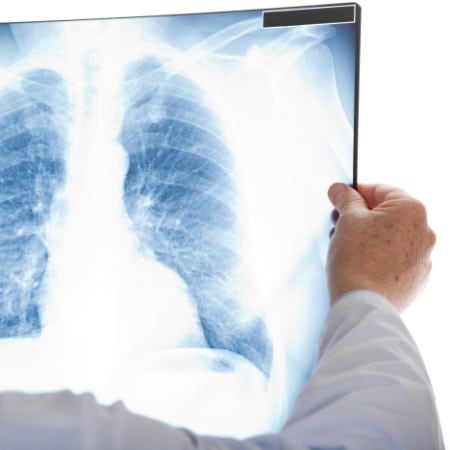A doctor holds up an X-ray of a human chest, displaying lungs and ribs in detail, examining it closely against a bright background.
